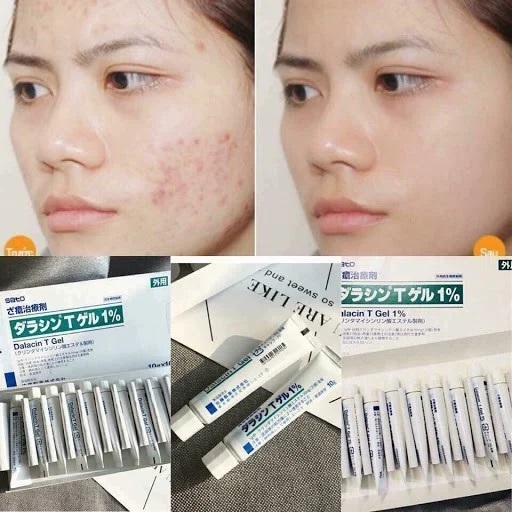 日本SATO佐藤製藥祛痘膏10g:圖片 5
