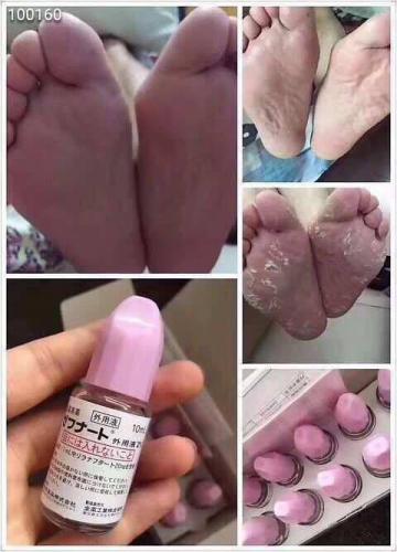 日本灰指甲腳氣水10ml:圖片 4